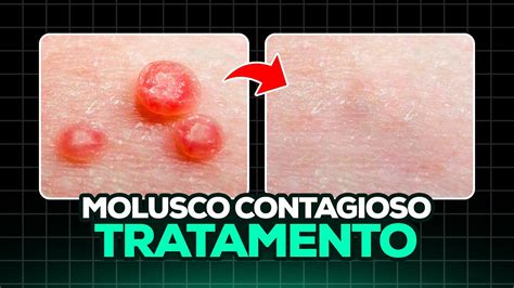 como eliminar molusco contagioso naturalmente|4 formas de tratar el Molusco (Molusco contagioso)